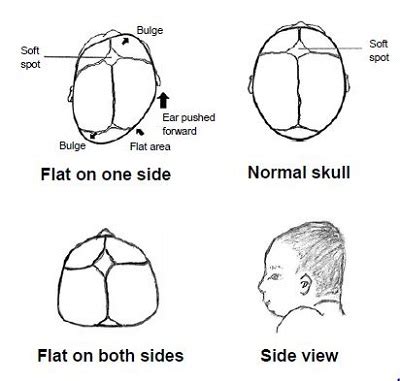 Plagiocephaly: What You Need to Know