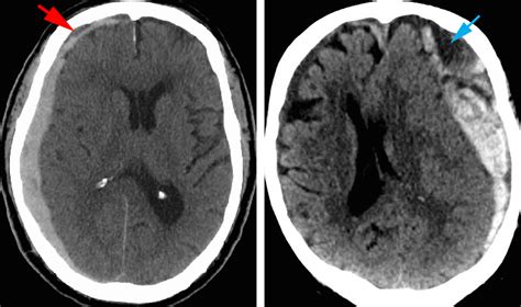 Acute Subdural Hematoma Mri | Porn Sex Picture