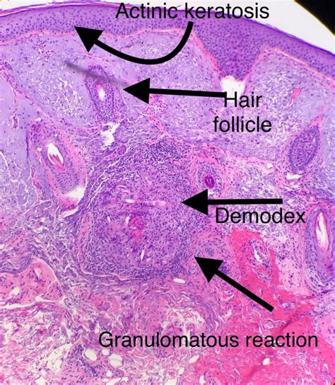 Demodex Mites Live on Our Skin - Pariser Dermatology