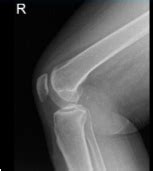 Operative Knee & Chondroplasty | Complete Orthopedics