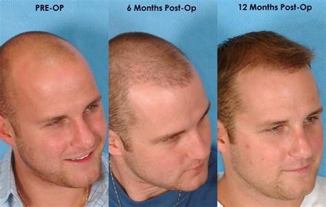 Which is the best hair transplant in Dubai? ~ Hair Transplant in Abu Dhabi