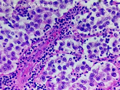 SEMINOMA- TESTIS - Pathology Made Simple