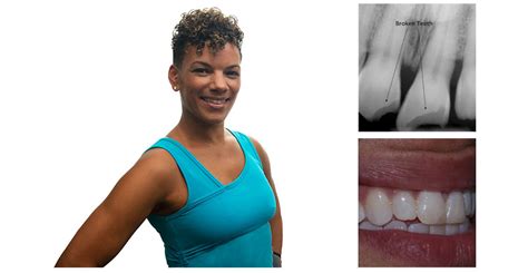 Atlanta Before and After Smile Gallery | Atlanta Top Cosmetic Dentist | Dental Implants 30309