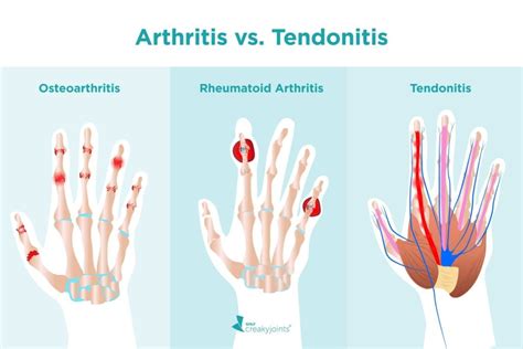 What’s the Difference Between Arthritis and Tendonitis?