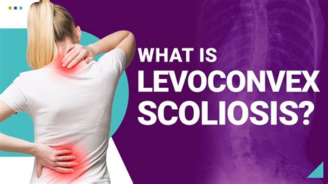 What is Levoconvex Scoliosis? - YouTube