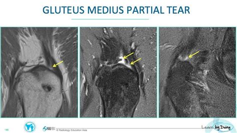 Hip MRI Gluteal Tendon Abnormalities - Radedasia