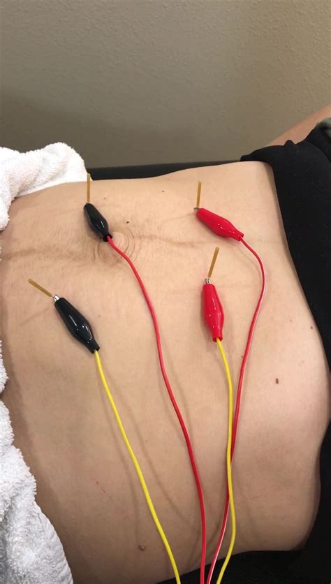 “You’re going to put a needle where?” Part II! Dry needling of the ...