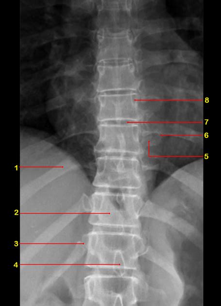 Lumbar Vertebrae Anatomy Xray