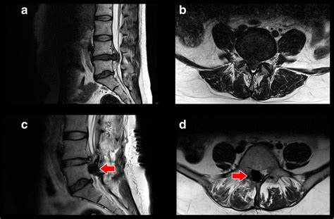 MRI T2 weight from the Lumbar spine. a and b show a massive Lumbar Disc... | Download Scientific ...