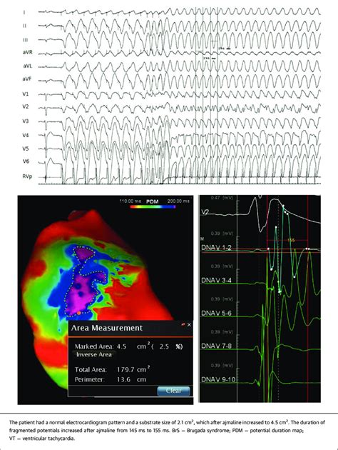 Before Ajmaline, Monomorphic VT Was Induced With Triple... | Download ...