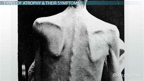 Atrophy: Definition, Types & Symptoms - Video & Lesson Transcript ...