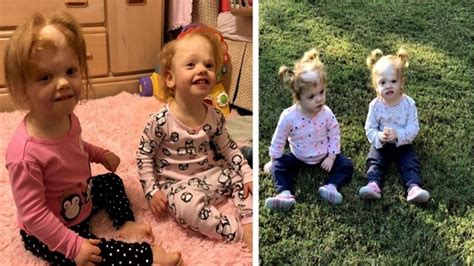 Formerly conjoined twins thriving after successful CHOP surgery | FOX 5 DC