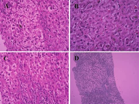 Liver histopathological findings. A) Cholestasis: Bile pigments within... | Download Scientific ...