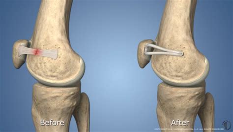 MPFL Repair / Reconstruction | Dr. Patrick Chin Orthopedic Surgeon Vancouver