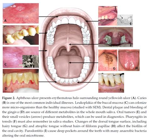 Aphthous ulcer presents erythematous halo surrounding round yellowish... | Download Scientific ...