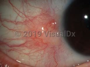 Nodular scleritis