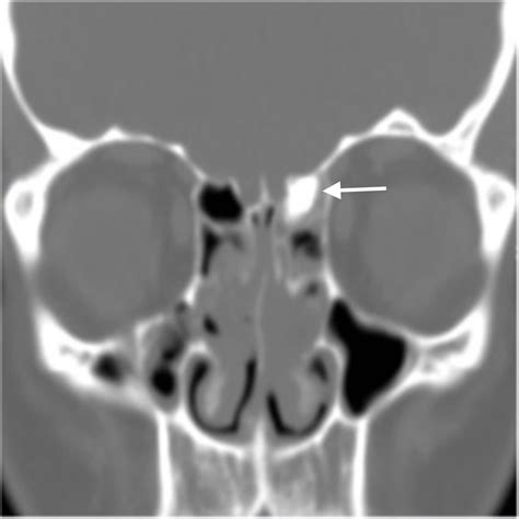 Maxillary And Ethmoid Sinus Disease