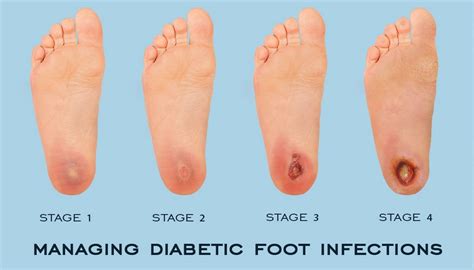 Foot ulcer stages pictures 1 | Symptoms and pictures