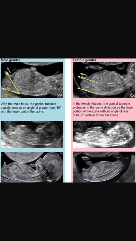 Can An Ultrasound Technician Tell You Results - resultszf