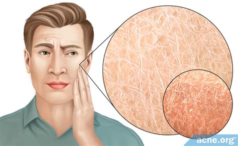 Dry Skin: Causes and Treatments - Acne.org