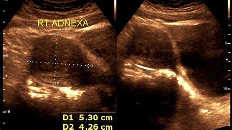 Ultrasound cases 478 of 2000 || Endometriosis (Chocolate Cysts ...