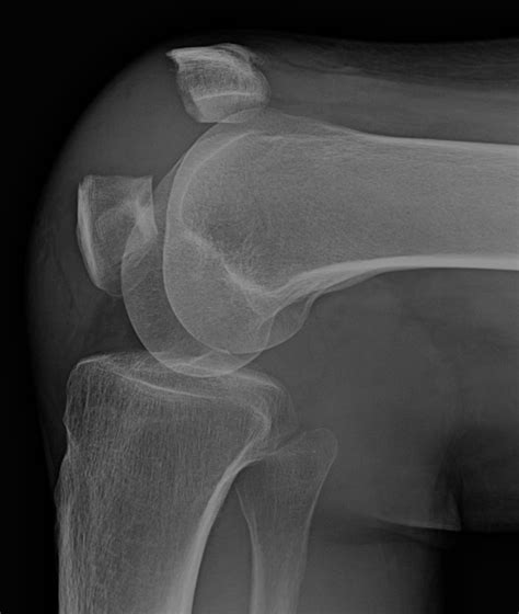 Patella Fracture — Adam B. Cohen, MD