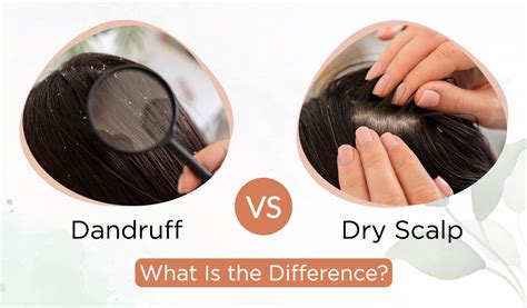 Dandruff Vs Dry Scalp: What Is the Difference? - The Indie Earth