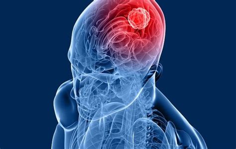 Benign Brain Tumor in Children | Malaysia | Red Cover