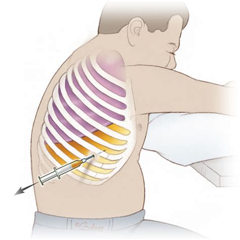 Thoracentesis Procedure - Ultrasound Guided Technique Training