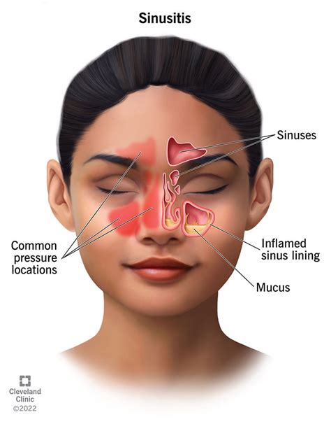 Sinus Infection (Sinusitis): Causes, Symptoms Treatment | atelier-yuwa.ciao.jp