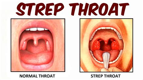 Strep Throat Blisters