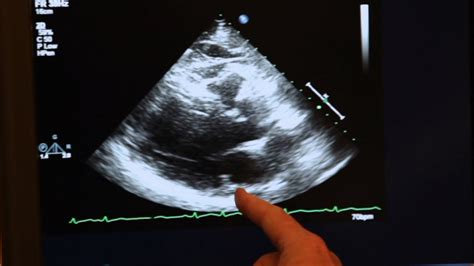 Echocardiogram Demonstration - YouTube