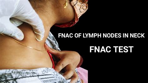 FNAC Test for Lymph Nodes in Neck।। - YouTube