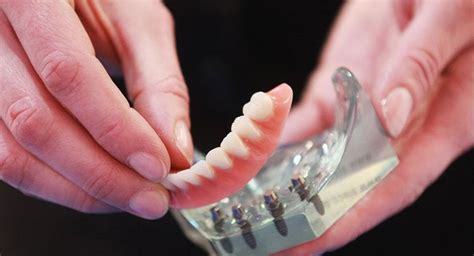 How to Care For Your Snap On Denture - Top Rated Cosmetic & General Dentist in Mesa AZ 85203 ...