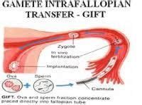 Gamete Intra-Fallopian Tube Transfer in Rohini Sector 8, New Delhi, Priory Clinic-IVF Expert ...