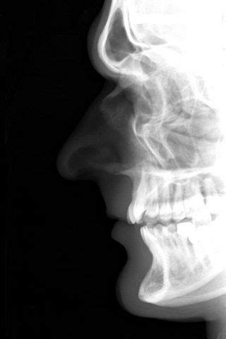 Nasal Bone Anatomy Radiology - Radiographic Anatomy - Sinuses - Lateral ...