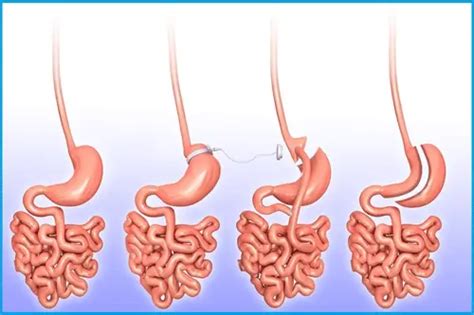 gastric sleeve recovery time - Medgol