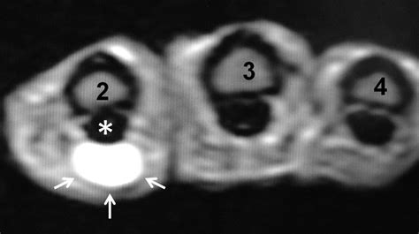 -MRI showing the ganglion cyst at the index finger around A2 pulley ...