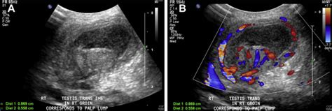 Ultrasound of the testis showing A. a normal sized testis surrounded by... | Download Scientific ...