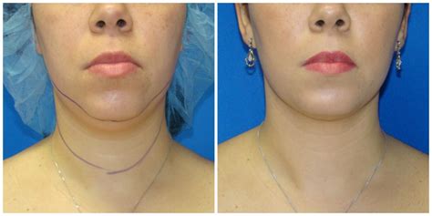 Chin Liposuction / Smartlipo in Houston TX