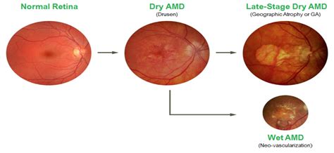 [DIAGRAM] Macular Degeneration Eye Diagram - MYDIAGRAM.ONLINE