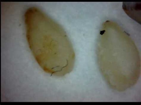 morgellons disease treatment - pictures, photos