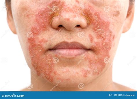 Seborrheic Dermatitis on Face Stock Image - Image of face, closeup: 111929973