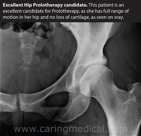 The evidence for hip replacement alternatives – Caring Medical