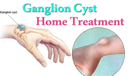 Ganglion Cyst Jaw