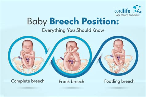 Baby Breech Position: Everything You Should Know