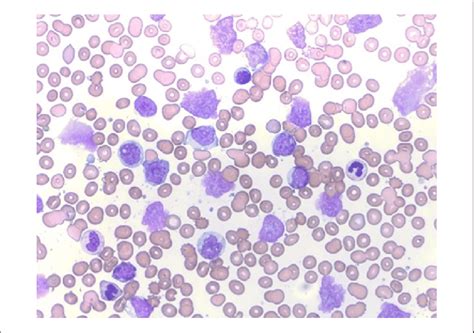 Peripheral blood smear showing an increased number of lymphocytes. Both ...