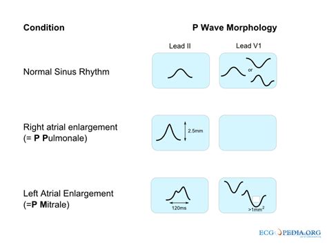 P wave - wikidoc