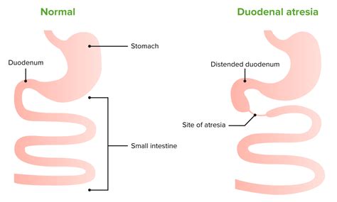 Congenital Duodenal Obstruction | Concise Medical Knowledge