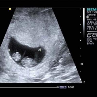 Identify monochorionic twins to guide pregnancy management | MDedge ObGyn